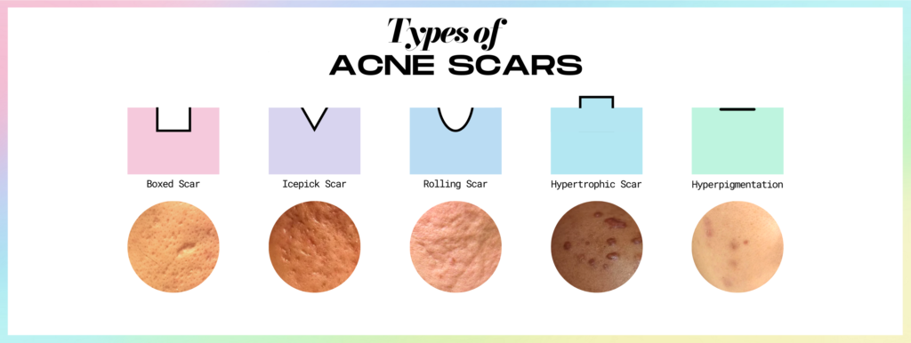 ALLYOUCANFACE_acne scars_acne_acne scar types_acne treatment_skincare_skin