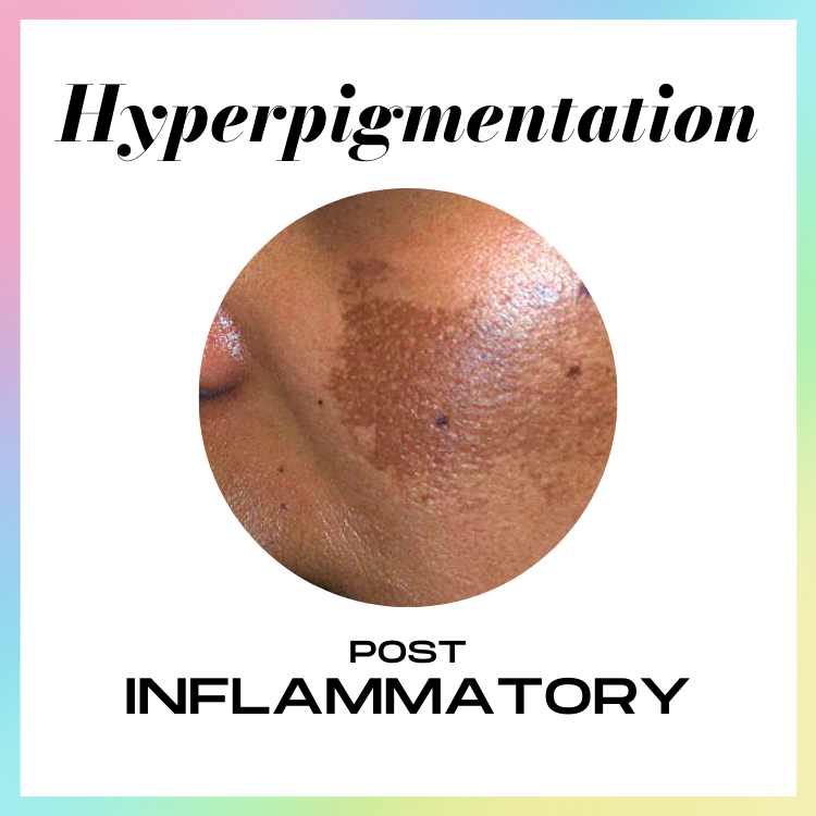 ALLYOUCANFACE_ HYPERPIGMENTATION_SKINCARE_SKIN TREATMENT_SKIN HEALTH_ Melasma