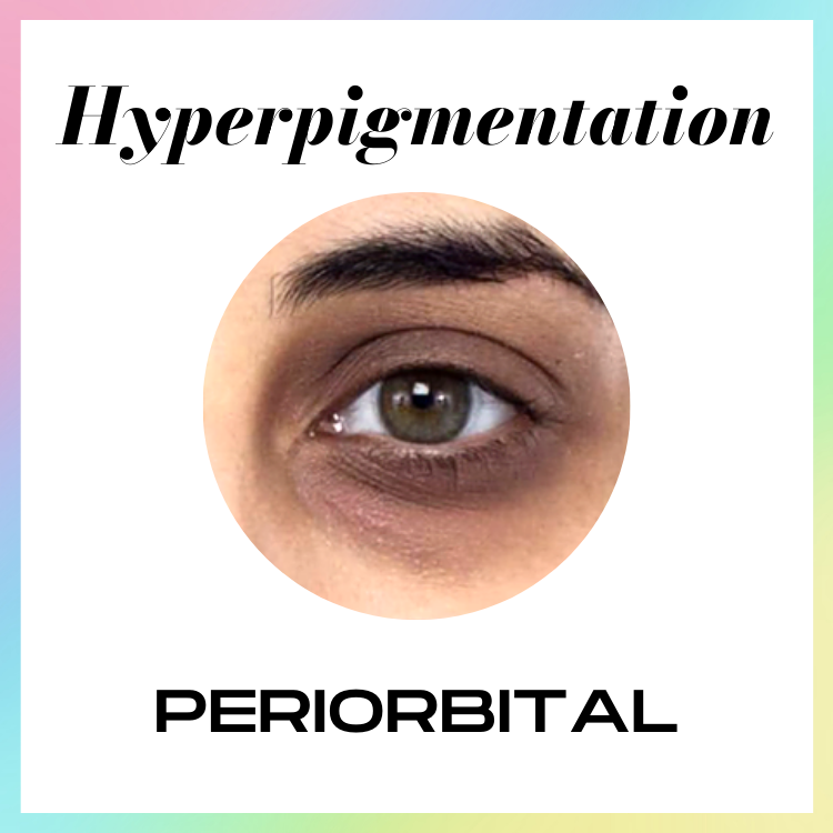 ALLYOUCANFACE_ HYPERPIGMENTATION_SKINCARE_SKIN TREATMENT_SKIN HEALTH_