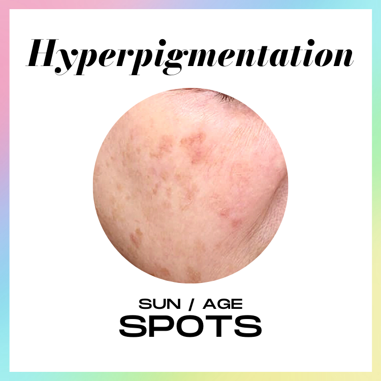 ALLYOUCANFACE_ HYPERPIGMENTATION_SKINCARE_SKIN TREATMENT_SKIN HEALTH_melasma , hyperpigmentation